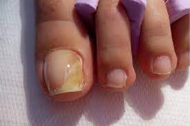how can i solve my nails fungus problem