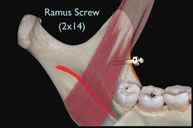 Forty Consecutive Ramus Bone Screws Used to Correct Horizontally Impacted  Mandibular Molars