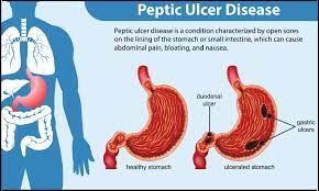 peptic ulcers causes risk factors