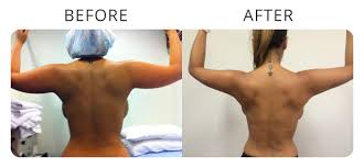 liposuction in newcastle my cosmetic