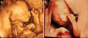 cleft lip in a fetus at 24 weeks