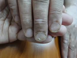 nails changes and disorders in elderly