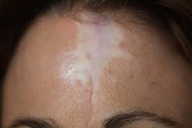 permanent makeup for scar camouflage
