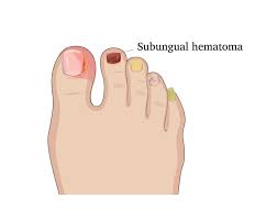 what is a subungual hematoma how to