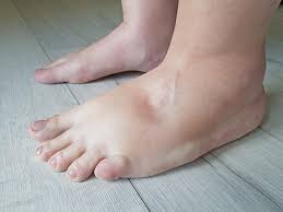 swollen or inflamed feet