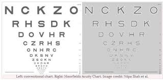 Moorfields Acuity Chart Detects Early Age Related Macular