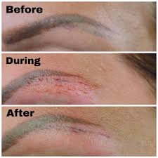 tattoo removal microblading