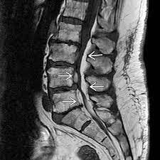 epidural lipomatosis radiology key