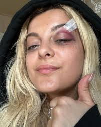 bebe rexha shows off black eye after