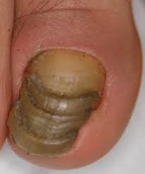 shrimp nail malalignment onychotrohy