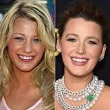do-all-hollywood-stars-have-veneers
