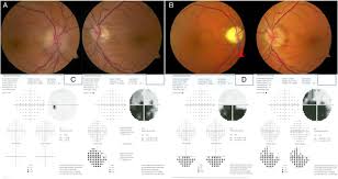 Anterior ischemic optic neuropathy (aion) is an eye disease characterized by infarction of the optic disk leading to vision loss. Progression Of Asymptomatic Optic Disc Swelling To Non Arteritic Anterior Ischaemic Optic Neuropathy British Journal Of Ophthalmology