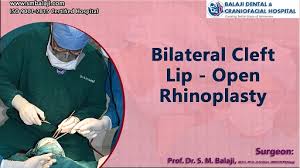 open rhinoplasty cost in india