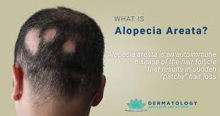 alopecia areata sjh derm