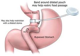 bariatric revision surgery revisional