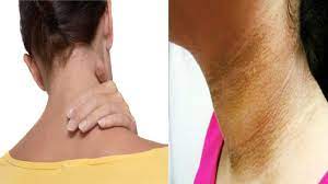 how to remove blackness of neck gardan ka kalapan kese door kare brmp |  remove blackness of neck: गर्दन का कालापन मिनटों में दूर कर देंगी ये चीजें,  जानें उपयोग का आसान