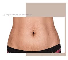 stretch mark removal laser treatment
