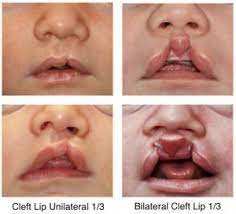 cleft lip and cleft palate dell