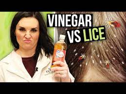 apple cider vinegar for head lice
