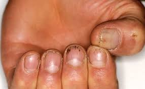 nail psoriasis on the hands and feet