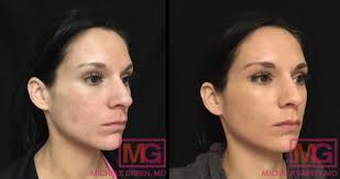 acne scar treatments with juvederm dr