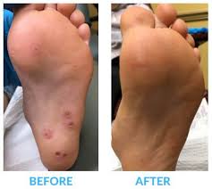 swift treatment for plantar warts in