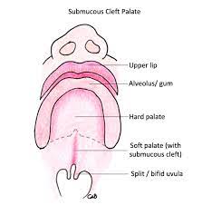 of cleft explained cleft lip palate