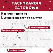 EKG po polsku - Home | Facebook