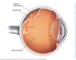 However, other vision issues — like retinal tears or detachment — could be hereditary. Retinal Detachment Symptoms And Causes Mayo Clinic