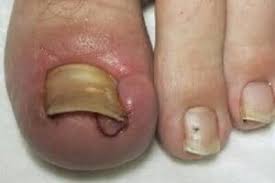 ingrown toe nail orangeville foot clinic