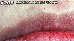 206 blackheads around the lips b