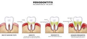 ses of gum disease periodonis