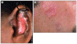 systemic lupus erythematosus