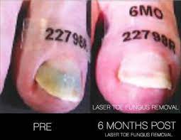 laser toe fungus removal in toronto