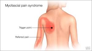 Mayo Clinic Q And A Understanding Myofascial Pain Syndrome