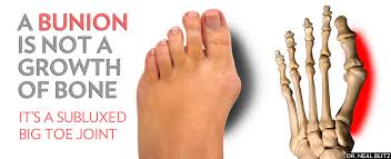 Image result for BUNIONS