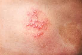 shingles vs herpes outbreak symptoms