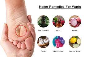 natural home remes for warts the