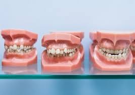 Depending on the severity of the underbite, extracting one or more teeth from the lower jaw may also help improve the appearance of an underbite. Treatment Options For Overbites Underbites Crossbites Angela Evanson Dds In Parker Co Dentist 720 409 0008 80134
