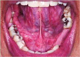normal floor of mouth