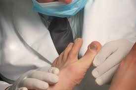 treatment for ingrown nail in costa rica