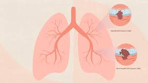 types of lung cancer overview