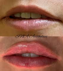 lip filler common questions sna