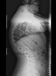 Scheuermann's kyphosis involves wedging of vertebrae (generally thoracic) which creates a kyphotic deformity >45 degrees. Scheuermann S Kyphosis Spine Orthobullets