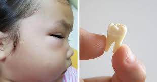 Rasa sakit akibat gusi bengkak membuat nafsu makan kita salah satu penyakit gangguan mulut dan gusi ini mempunyai nama lain yaitu gingivitis. Muka Anak Bengkak Lepas 3 Hari Tahan Sakit Gigi Suka Makan Manis Tak Berus Gigi Setiap Hari Jadi Punca Pa Ma