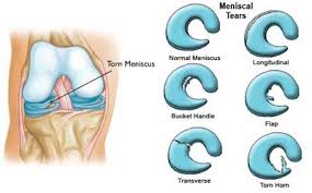 physical therapy to treat torn meniscus