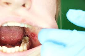 Eine mundschleimhautentzündung durch herpesviren bezeichnet man als mundfäule. Mundschleimhautentzundung Ursachen Symptome Behandlung Medlexi De