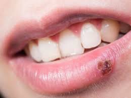 cold sores symptoms causes treatment