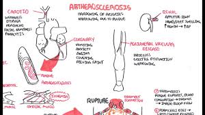 Atherosclerosis Pathophysiology
