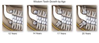 wisdom tooth removal hawthorne